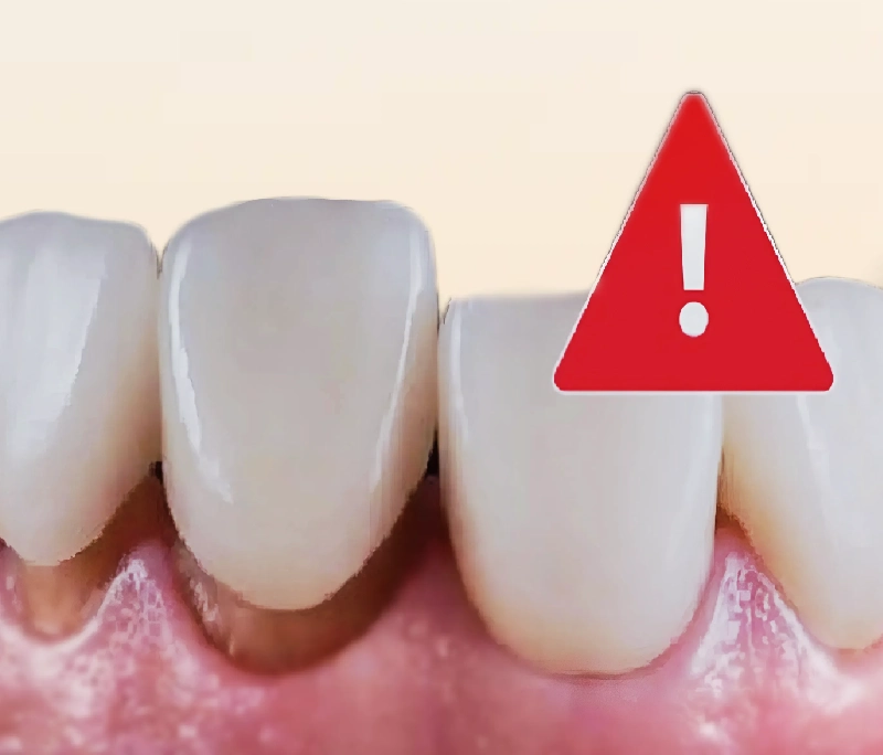 Bọc răng sứ bị hở có sao không? 5 biến chứng cực kỳ nguy hiểm cần biết